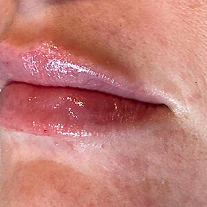 Lip Filler Before and After Photo by Coachlight Clinic & Spa in West Des Moines Iowa