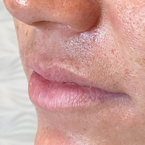 Lip Filler Before and After Photo by Coachlight Clinic & Spa in West Des Moines Iowa