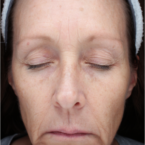 HALO Before and After Photo by Coachlight Clinic & Spa in West Des Moines Iowa