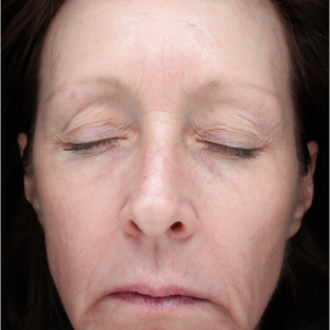 HALO Before and After Photo by Coachlight Clinic & Spa in West Des Moines Iowa
