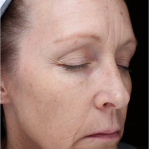 HALO Before and After Photo by Coachlight Clinic & Spa in West Des Moines Iowa