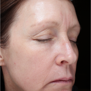 HALO Before and After Photo by Coachlight Clinic & Spa in West Des Moines Iowa