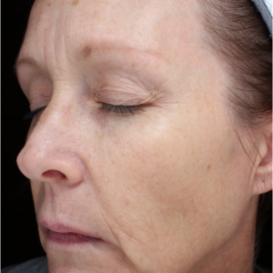 HALO Before and After Photo by Coachlight Clinic & Spa in West Des Moines Iowa