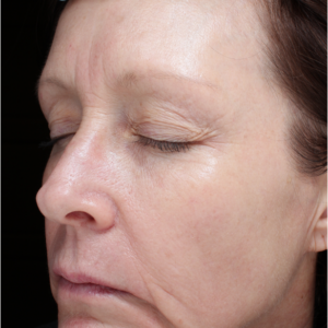 HALO Before and After Photo by Coachlight Clinic & Spa in West Des Moines Iowa