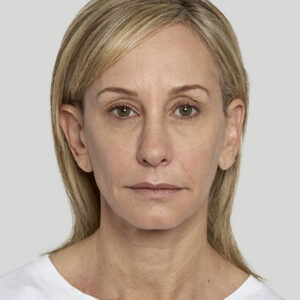 Sculptra Before and After Photo by Coachlight Clinic & Spa in West Des Moines Iowa