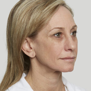Sculptra Before and After Photo by Coachlight Clinic & Spa in West Des Moines Iowa