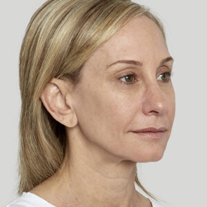 Sculptra Before and After Photo by Coachlight Clinic & Spa in West Des Moines Iowa