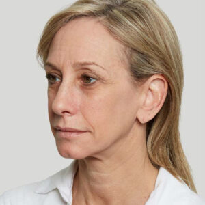 Sculptra Before and After Photo by Coachlight Clinic & Spa in West Des Moines Iowa
