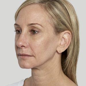Sculptra Before and After Photo by Coachlight Clinic & Spa in West Des Moines Iowa