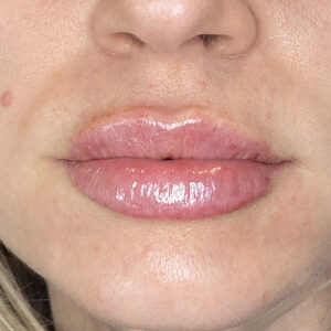 Lip Filler Before and After Photo by Coachlight Clinic & Spa in West Des Moines Iowa