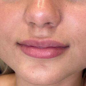 Lip Filler Before and After Photo by Coachlight Clinic & Spa in West Des Moines Iowa