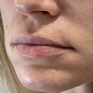 Lip Filler Before and After Photo by Coachlight Clinic & Spa in West Des Moines Iowa
