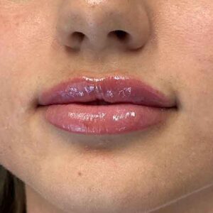 Lip Filler Before and After Photo by Coachlight Clinic & Spa in West Des Moines Iowa
