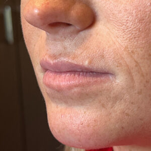 Lip Filler Before and After Photo by Coachlight Clinic Spa in West Des Moines Iowa