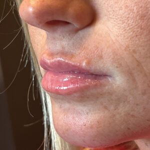 Lip Filler Before and After Photo by Coachlight Clinic Spa in West Des Moines Iowa