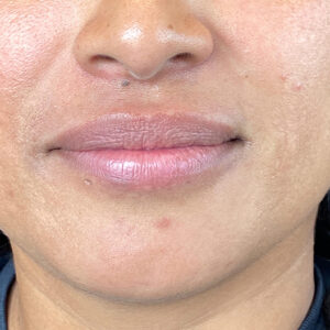 Lip Filler Before and After Photo by Coachlight Clinic Spa in West Des Moines Iowa