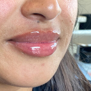 Lip Filler Before and After Photo by Coachlight Clinic Spa in West Des Moines Iowa