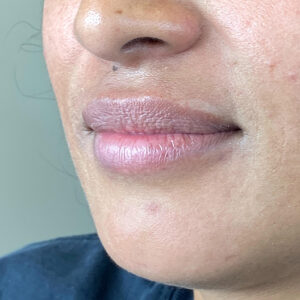 Lip Filler Before and After Photo by Coachlight Clinic Spa in West Des Moines Iowa