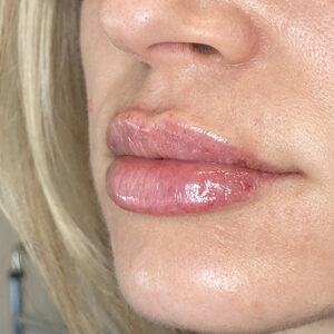 Lip Filler Before and After Photo by Coachlight Clinic & Spa in West Des Moines Iowa