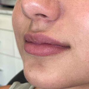 Lip Filler Before and After Photo by Coachlight Clinic & Spa in West Des Moines Iowa