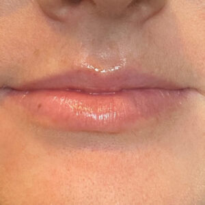 Lip Filler Before and After Photo by Coachlight Clinic & Spa in West Des Moines Iowa