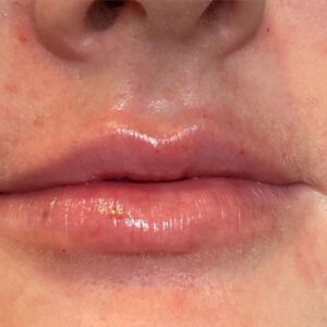 Lip Filler Before and After Photo by Coachlight Clinic & Spa in West Des Moines Iowa
