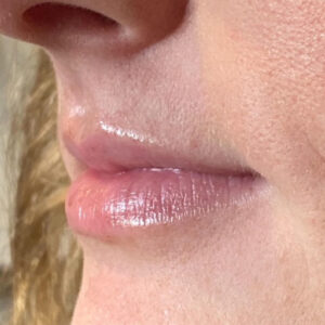 Lip Filler Before and After Photo by Coachlight Clinic & Spa in West Des Moines Iowa