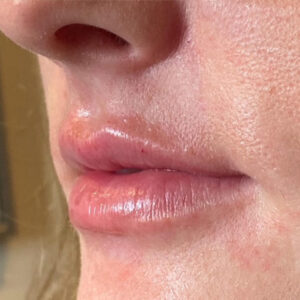 Lip Filler Before and After Photo by Coachlight Clinic & Spa in West Des Moines Iowa