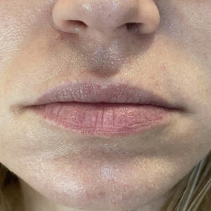 Lip Filler Before and After Photo by Coachlight Clinic & Spa in West Des Moines Iowa