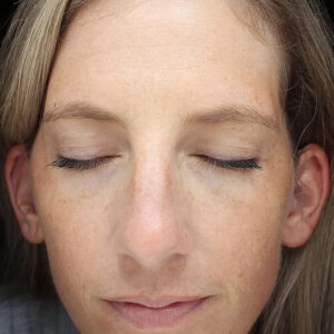 BBL® & BBL® HERO™ Before and After Photo by Coachlight Clinic & Spa in West Des Moines Iowa