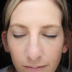 BBL® & BBL® HERO™ Before and After Photo by Coachlight Clinic & Spa in West Des Moines Iowa
