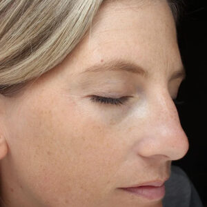 BBL® & BBL® HERO™ Before and After Photo by Coachlight Clinic & Spa in West Des Moines Iowa
