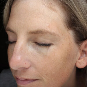 BBL® & BBL® HERO™ Before and After Photo by Coachlight Clinic & Spa in West Des Moines Iowa