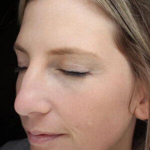 BBL® & BBL® HERO™ Before and After Photo by Coachlight Clinic & Spa in West Des Moines Iowa