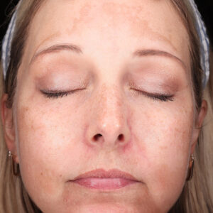 MOXI Before and After Photo by Coachlight Clinic & Spa in West Des Moines Iowa