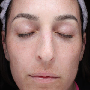 MOXI Before and After Photo by Coachlight Clinic Spa in West Des Moines Iowa