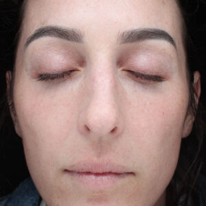MOXI Before and After Photo by Coachlight Clinic Spa in West Des Moines Iowa