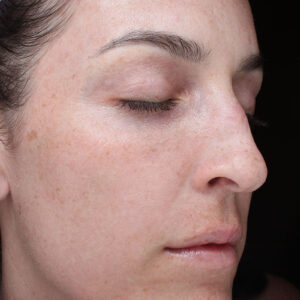 MOXI Before and After Photo by Coachlight Clinic Spa in West Des Moines Iowa