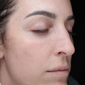 MOXI Before and After Photo by Coachlight Clinic Spa in West Des Moines Iowa