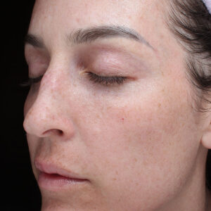 MOXI Before and After Photo by Coachlight Clinic Spa in West Des Moines Iowa .