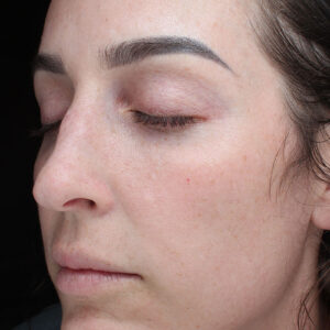 MOXI Before and After Photo by Coachlight Clinic Spa in West Des Moines Iowa