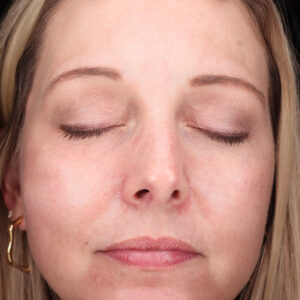 MOXI Before and After Photo by Coachlight Clinic & Spa in West Des Moines Iowa