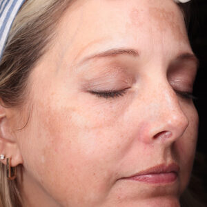 MOXI Before and After Photo by Coachlight Clinic & Spa in West Des Moines Iowa