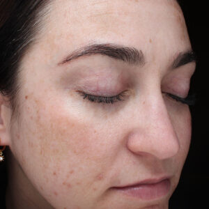 MOXI Before and After Photo by Coachlight Clinic Spa in West Des Moines Iowa