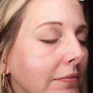 MOXI Before and After Photo by Coachlight Clinic & Spa in West Des Moines Iowa