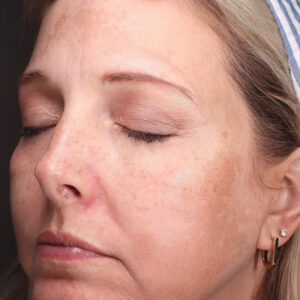 MOXI Before and After Photo by Coachlight Clinic & Spa in West Des Moines Iowa