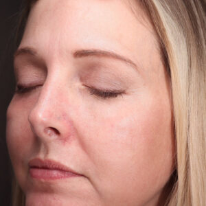 MOXI Before and After Photo by Coachlight Clinic & Spa in West Des Moines Iowa
