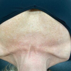 Neck after BBL