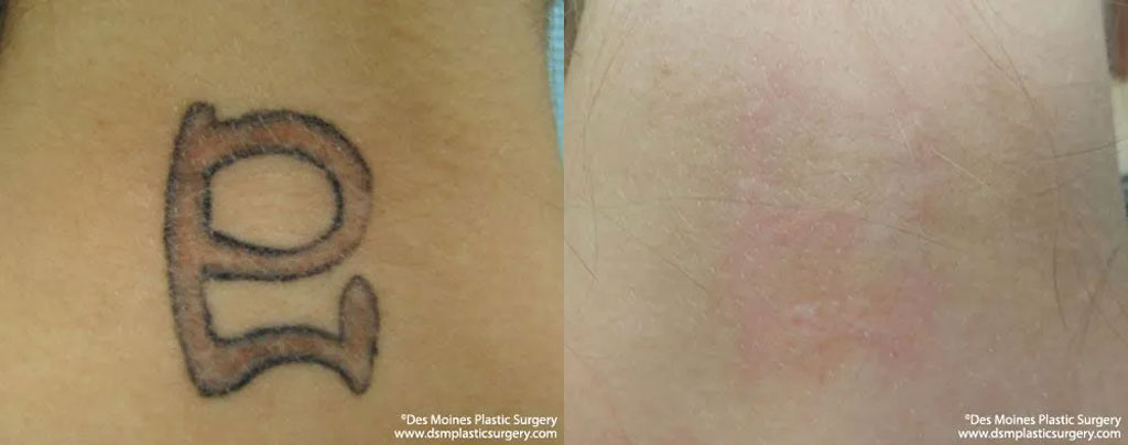 Laser Tattoo Removal Before And Afters
