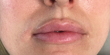 Lip Filler Before and After Photo by Coachlight Clinic & Spa in West Des Moines Iowa